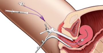 Продувание маточных труб что это такое