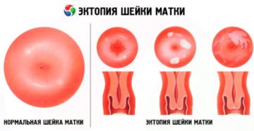 Эктопия шейки матки у нерожавших