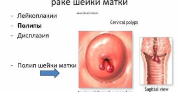 Что называют раком шейки матки