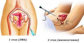 Лапароскопия и ЭМА при миоме матки больших размеров