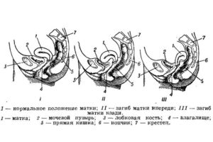 Позы для женщин с загибом матки