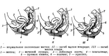 Позы для женщин с загибом матки