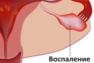 Воспаление яичников: лечение народными средствами