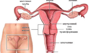 Что такое атрофия шейки матки