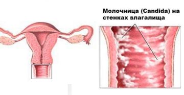 Причины вагинального кандидоза
