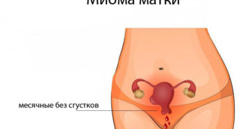 Месячные при миоме матки