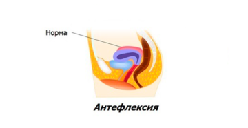 Антефлексия матки