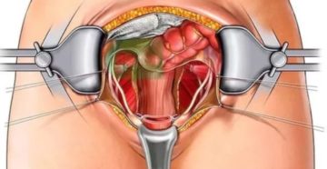 Последствия после удаления матки и шейки матки