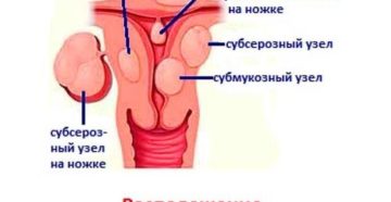 Интрамуральные узлы в матке