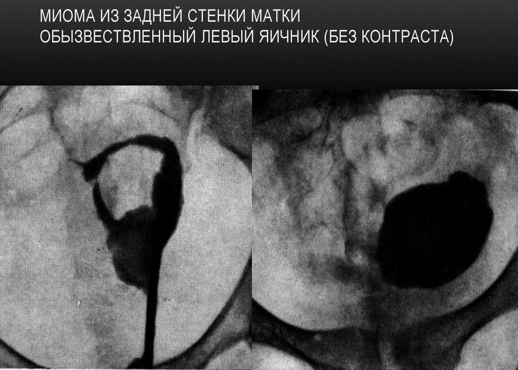 Миома на задней и передней стенках матки