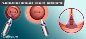 Что такое радиоволновая конизация шейки матки