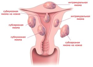 Интрамуральная миома матки