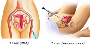 При каких размерах миомы матки делают операцию