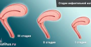 Инфантилизм матки