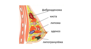 Жировик в грудной железе у женщин