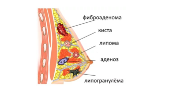 Жировик в грудной железе у женщин