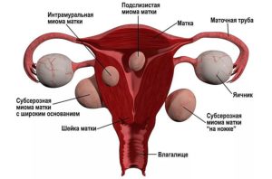 Разновидности миомы матки