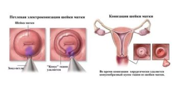 Конизация шейки матки послеоперационный период выделения