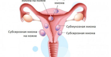 Интрамурально субмукозная миома матки