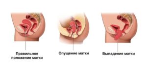 Операция при выпадении матки в пожилом возрасте