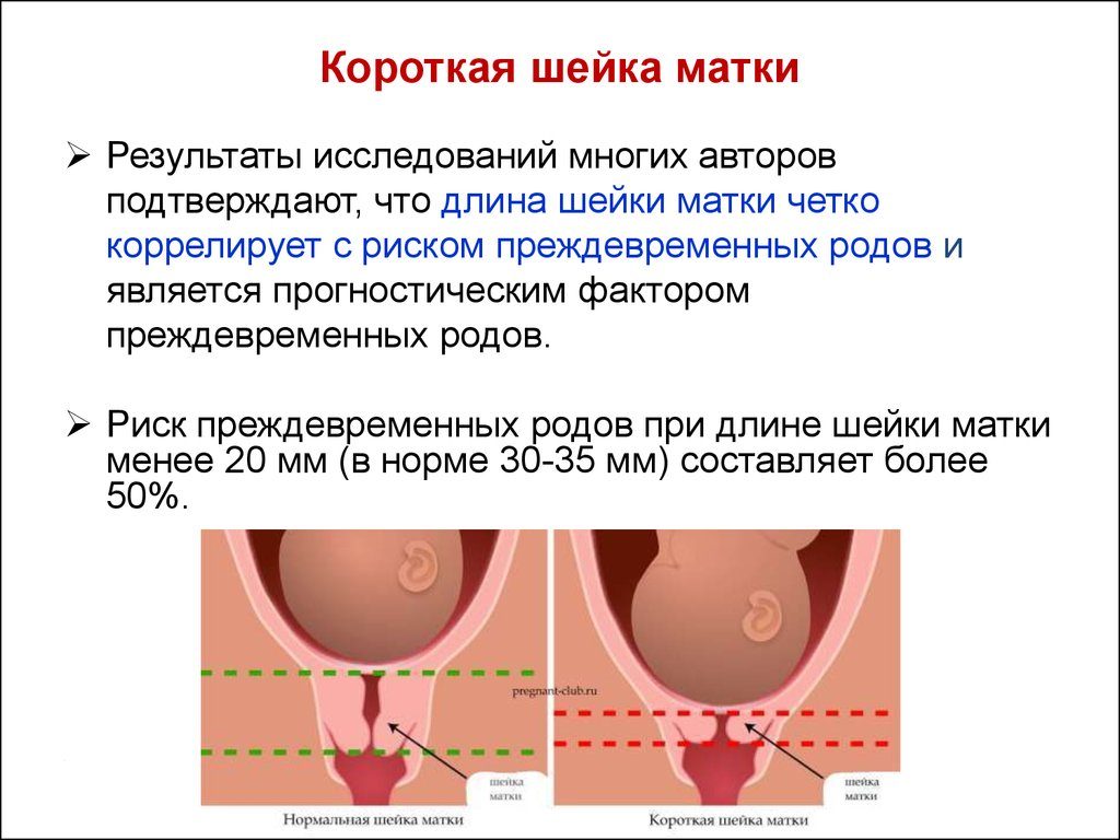 Почему укорачивается шейка матки при беременности