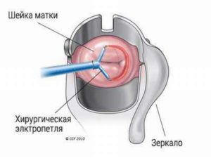 Метод диатермокоагуляции шейки матки