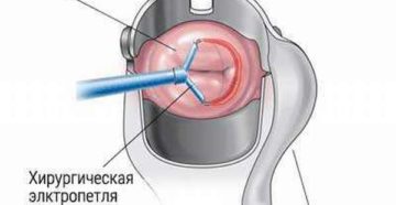 Метод диатермокоагуляции шейки матки
