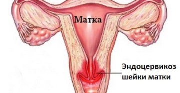 Стационарный эндоцервикоз шейки матки что это такое