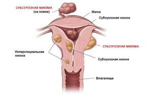 Симптомы и признаки субсерозной миомы матки