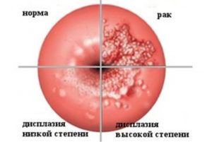 Дискариоз шейки матки