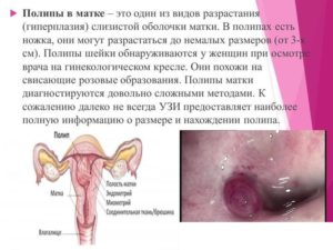 Причины возникновения полипа цервикального канала