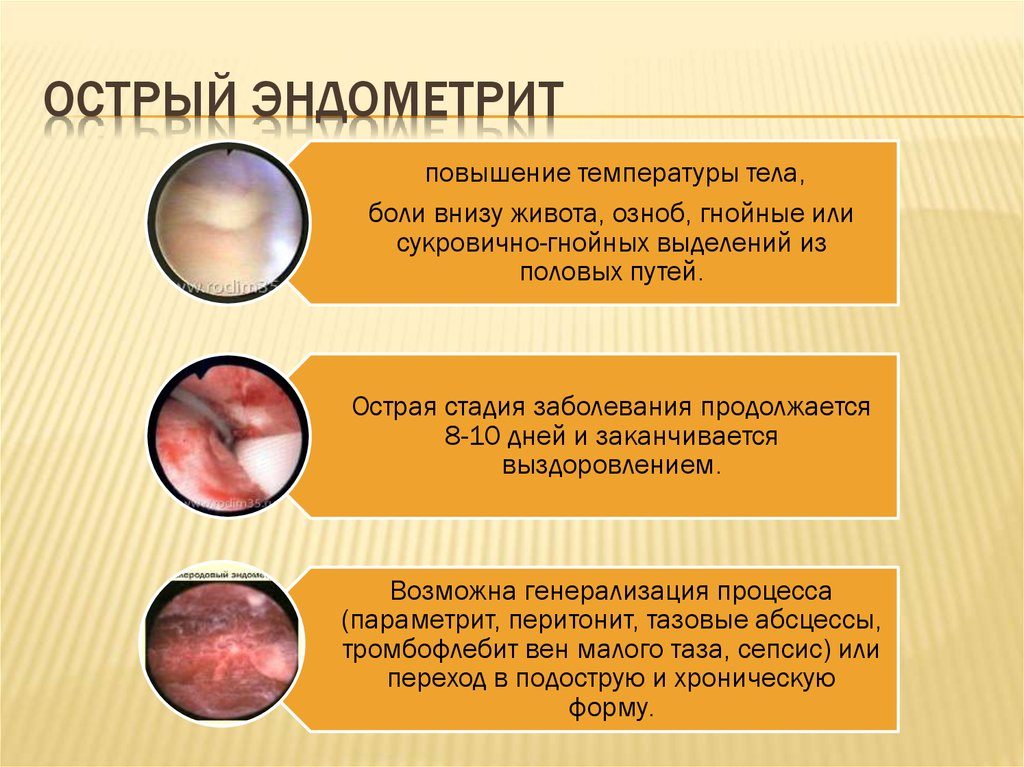 Что такое острый и подострый эндометрит