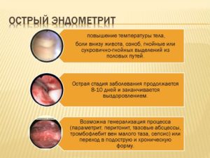 Что такое острый и подострый эндометрит