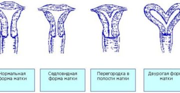 Что значит седловидная форма матки