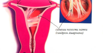 Синехии полости матки