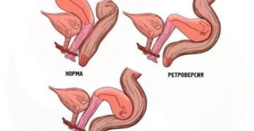 Что означает матка retroflexio
