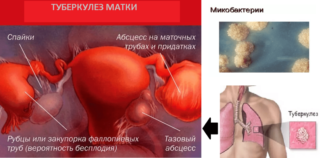 Туберкулез матки симптомы