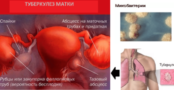 Туберкулез матки симптомы