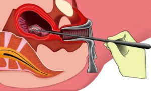 Выскабливание полости матки при кровотечении