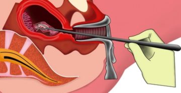 Выскабливание полости матки при кровотечении