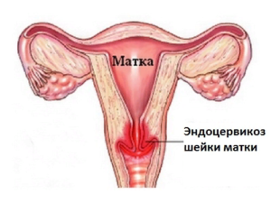 Что такое стационарный эндоцервикоз шейки матки