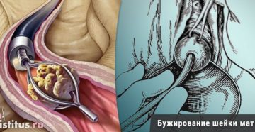 Бужирование цервикального канала что это такое