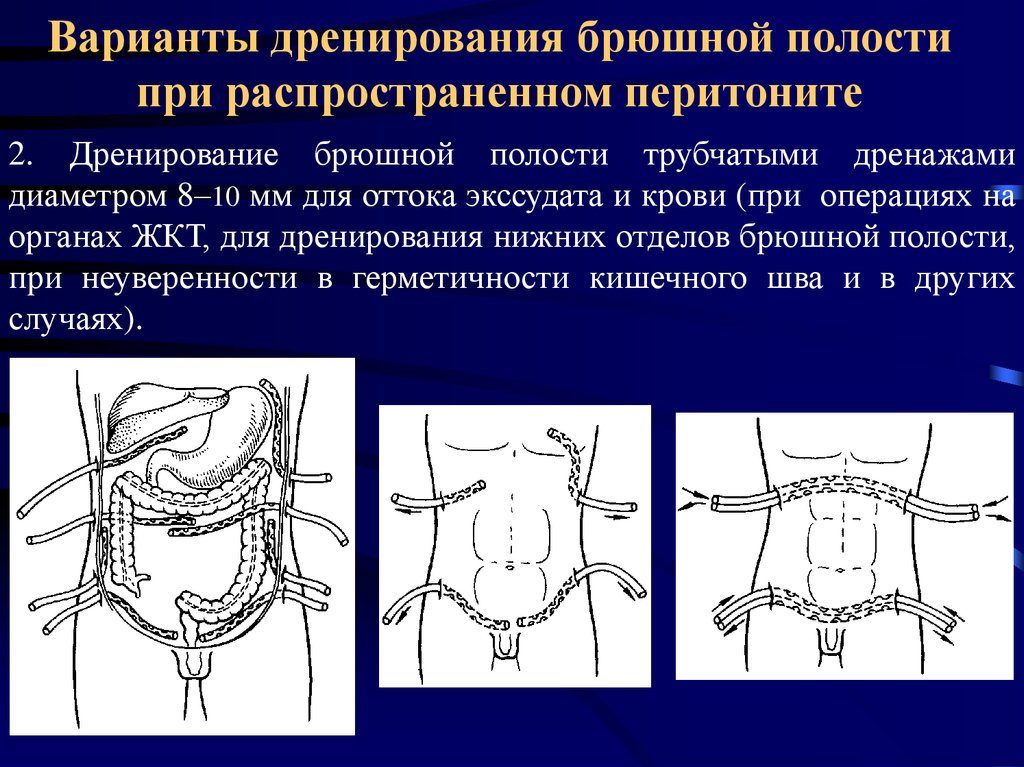 Дренирование брюшной полости что это такое