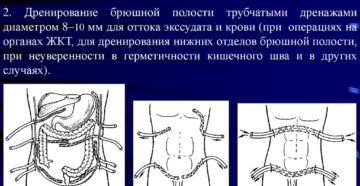 Дренирование брюшной полости что это такое