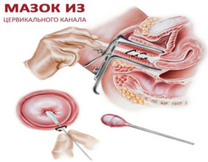 Соскоб с цервикального канала и шейки матки