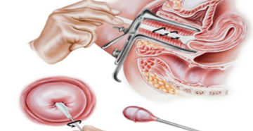 Соскоб с цервикального канала и шейки матки