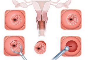 Почему возникает эрозия шейки матки