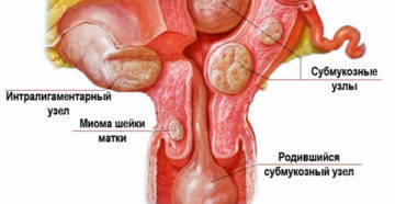 Что такое миома матки на шейке матки