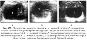 Симптомы эндометриоза мочевого пузыря у женщин