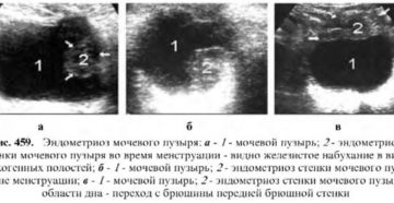 Симптомы эндометриоза мочевого пузыря у женщин